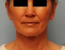 A result from PREMIERE Center for Cosmetic Surgery Tampa