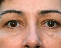 A result from PREMIERE Center for Cosmetic Surgery Tampa