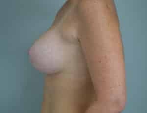 A result from John F. Farella, MD, FACS
