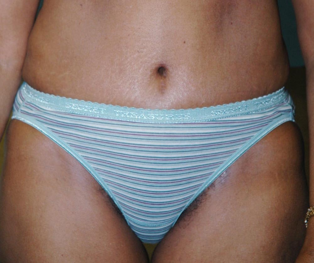 A result from The South Shore Cosmetic Surgeons