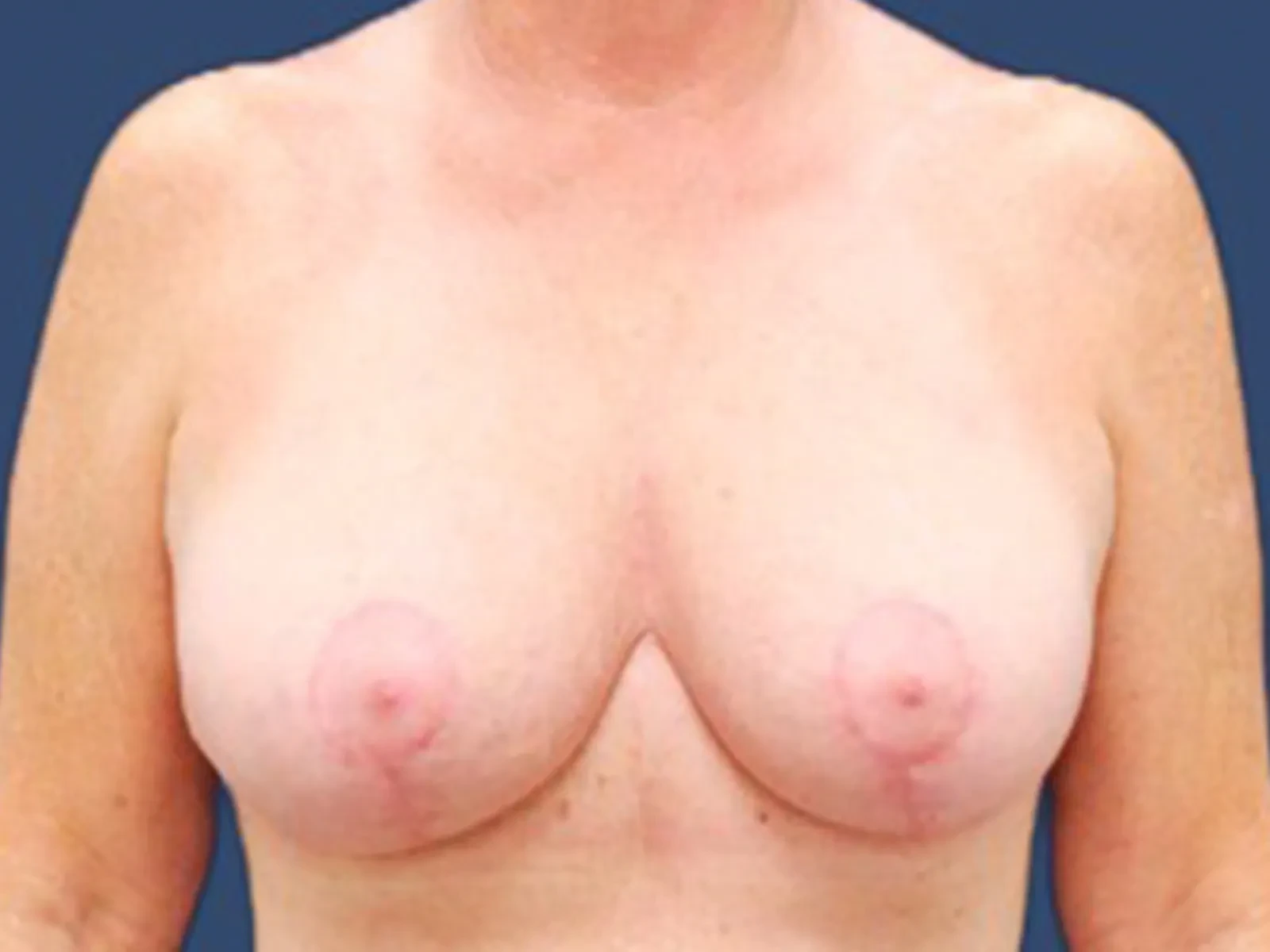 A result from Hill Country Plastic Surgery