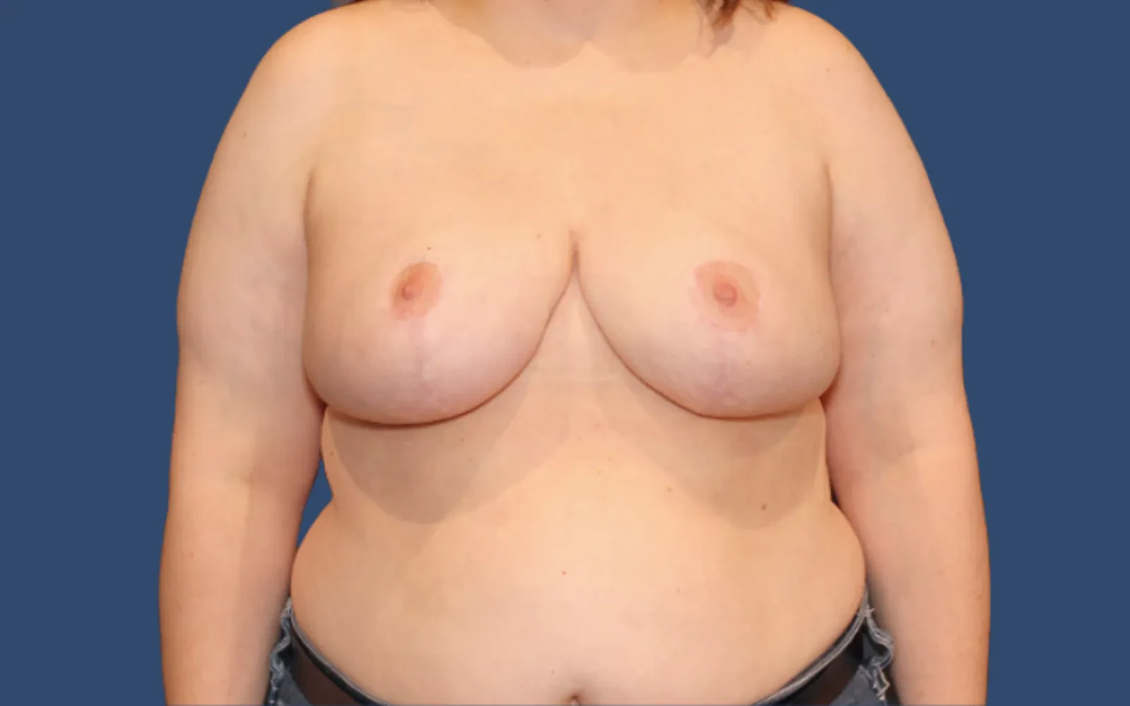 A result from Hill Country Plastic Surgery
