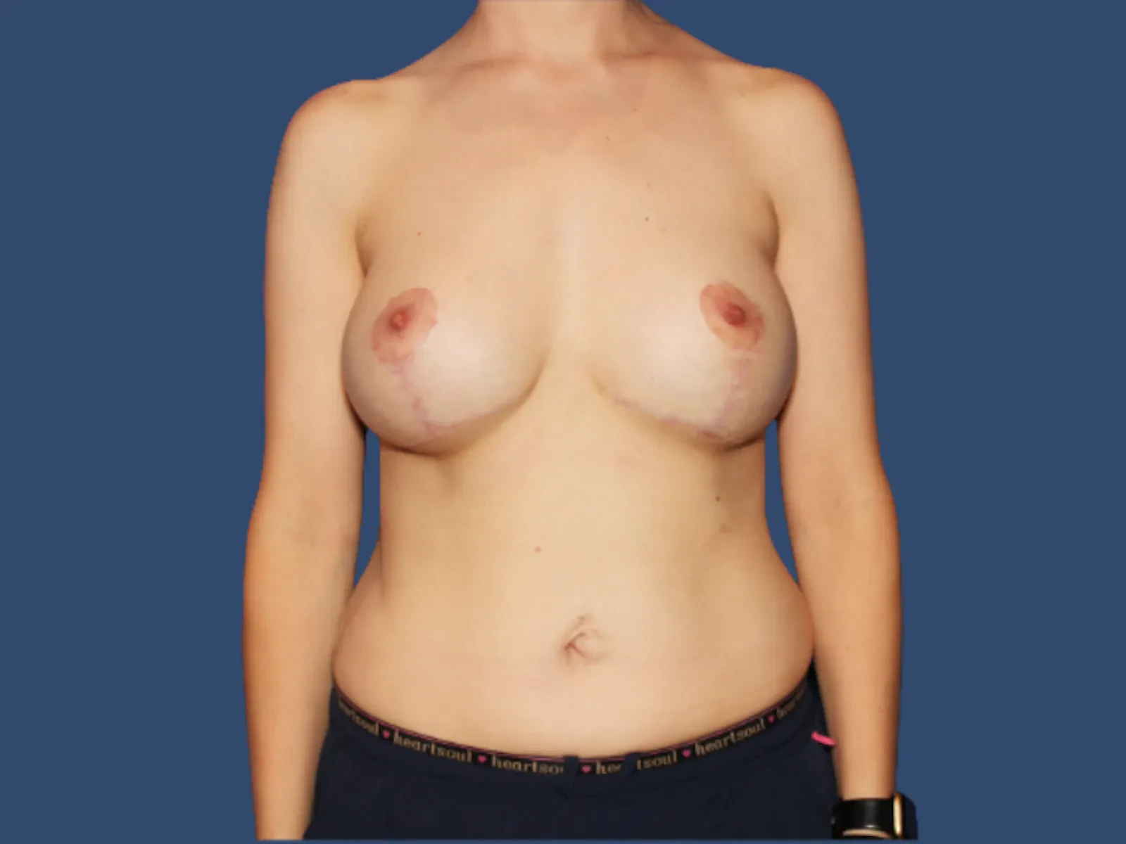 A result from Hill Country Plastic Surgery