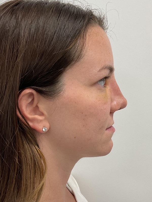 A result from New You Plastic Surgery