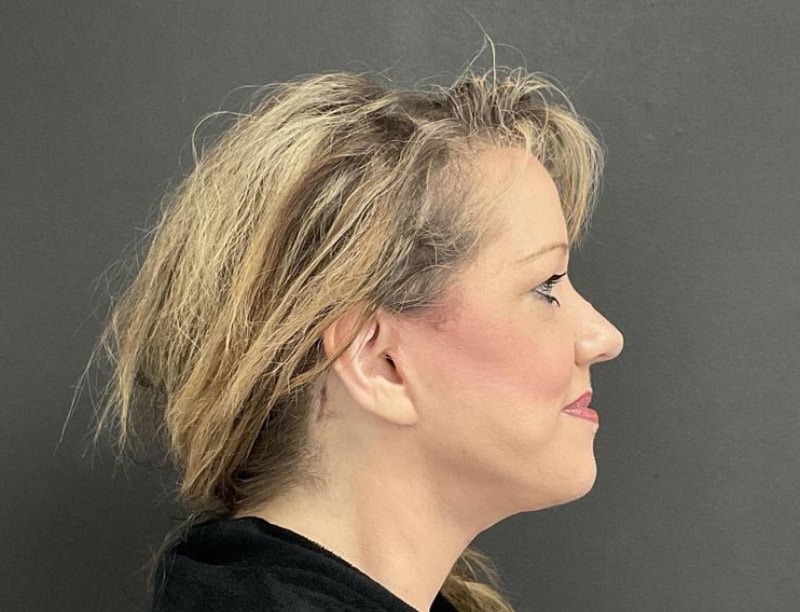 A result from Panache Plastic Surgery