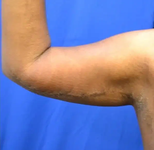 A result from Georgia Plastic & Reconstructive Surgery