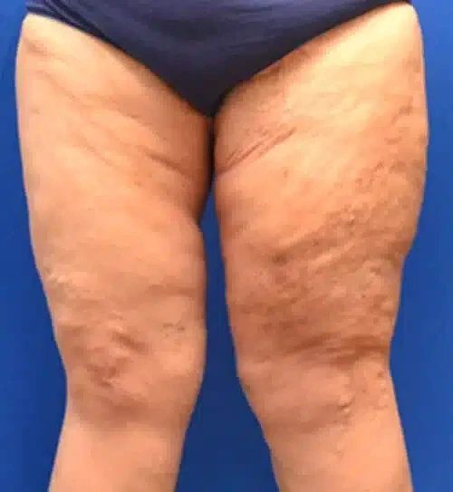 A result from Georgia Plastic & Reconstructive Surgery