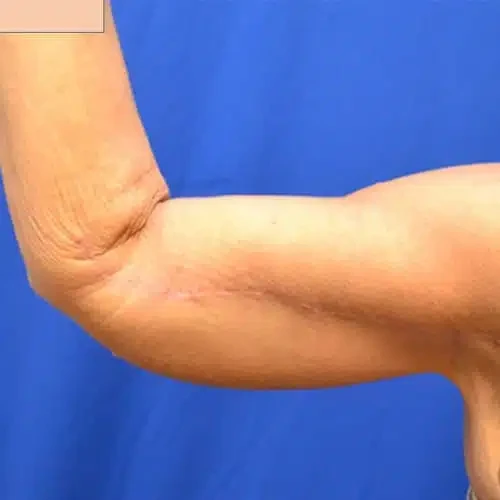 A result from Georgia Plastic & Reconstructive Surgery