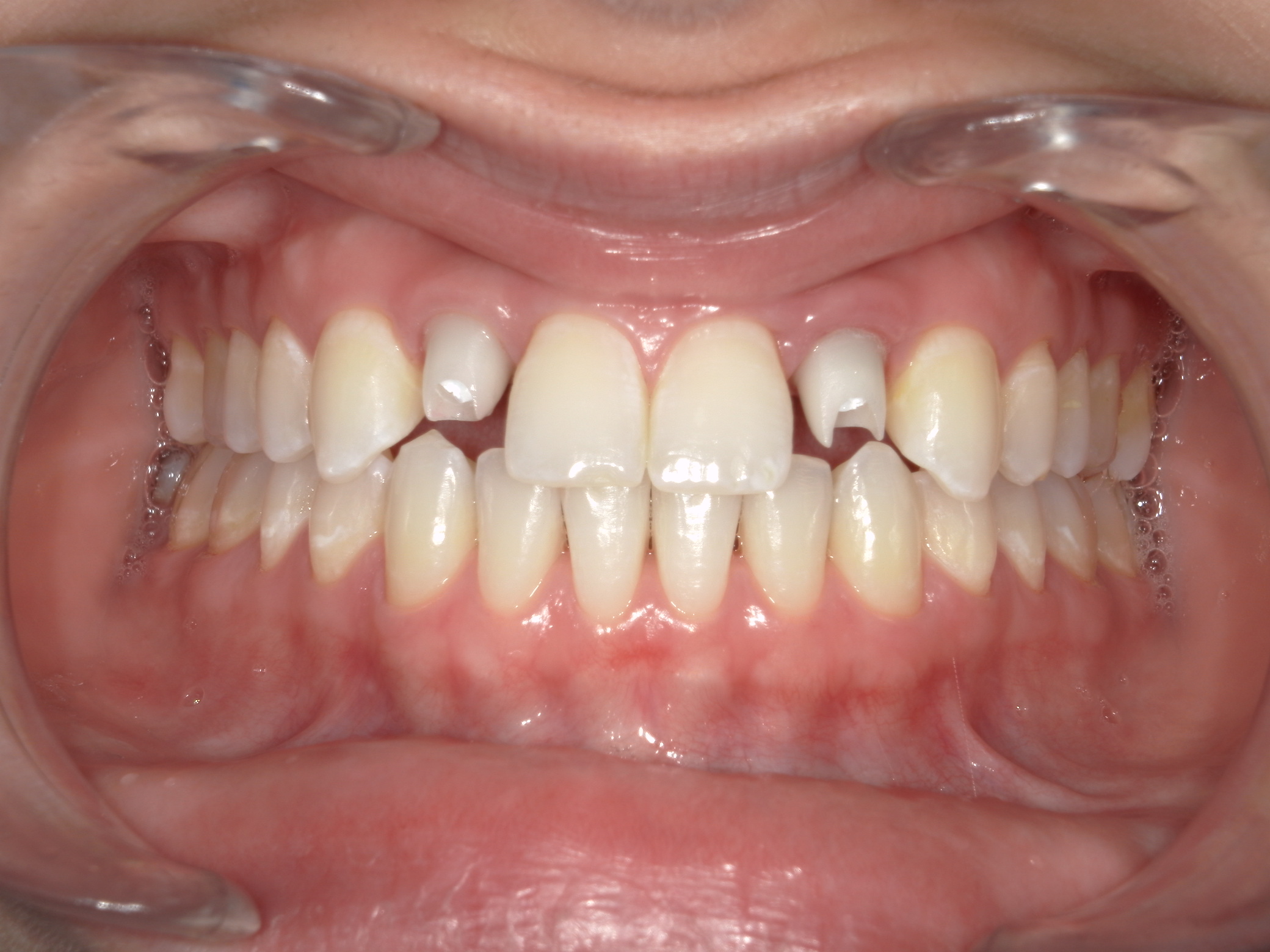 Smile Makeover