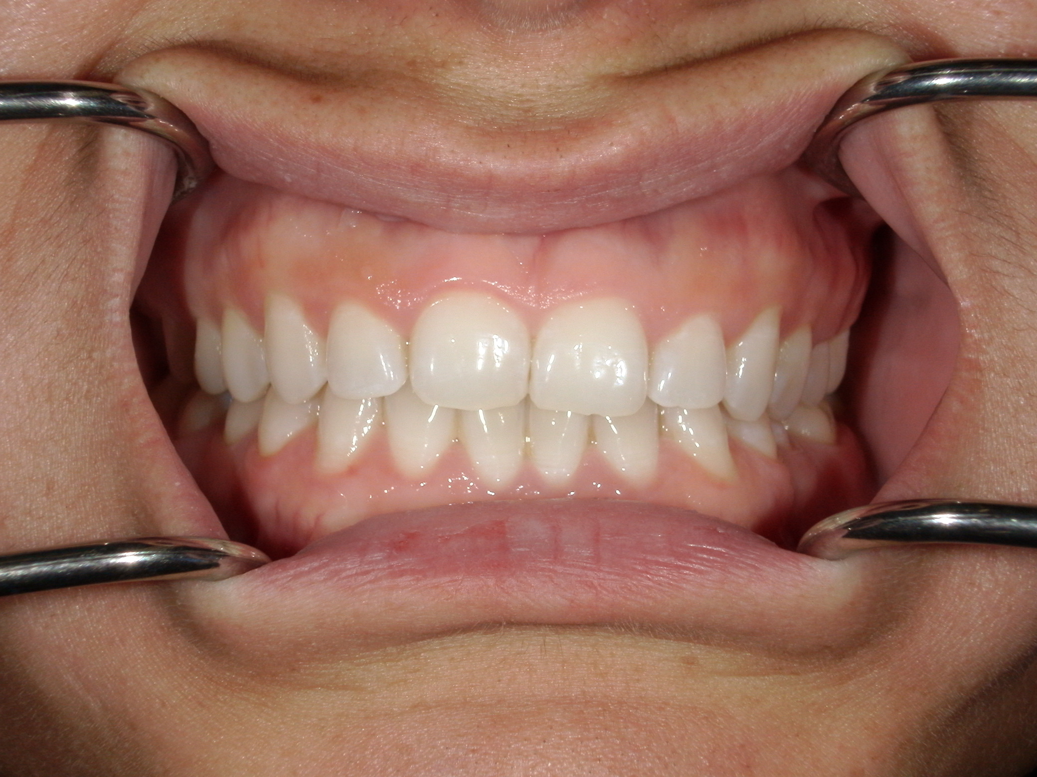 Smile Makeover