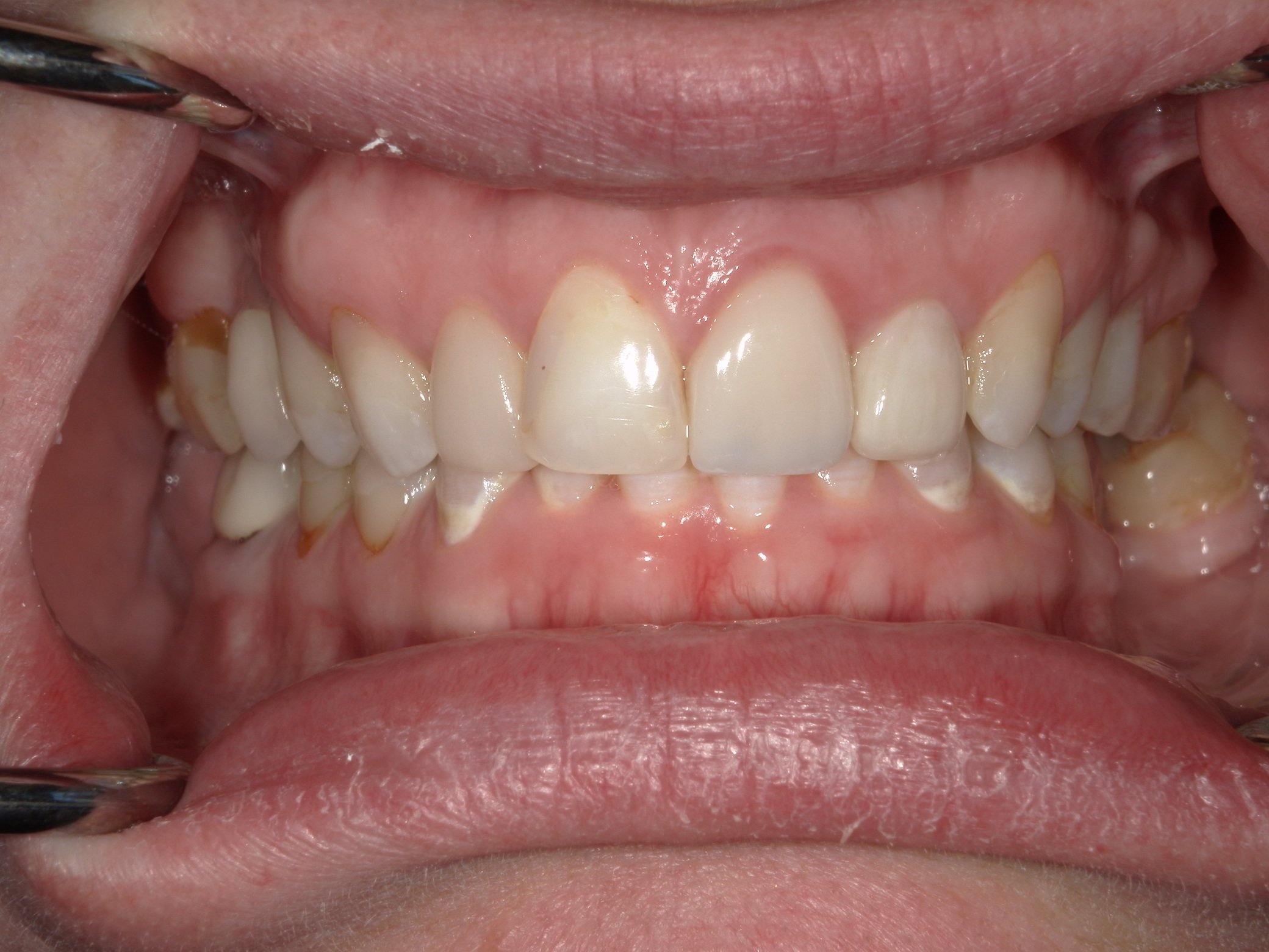 Smile Makeover