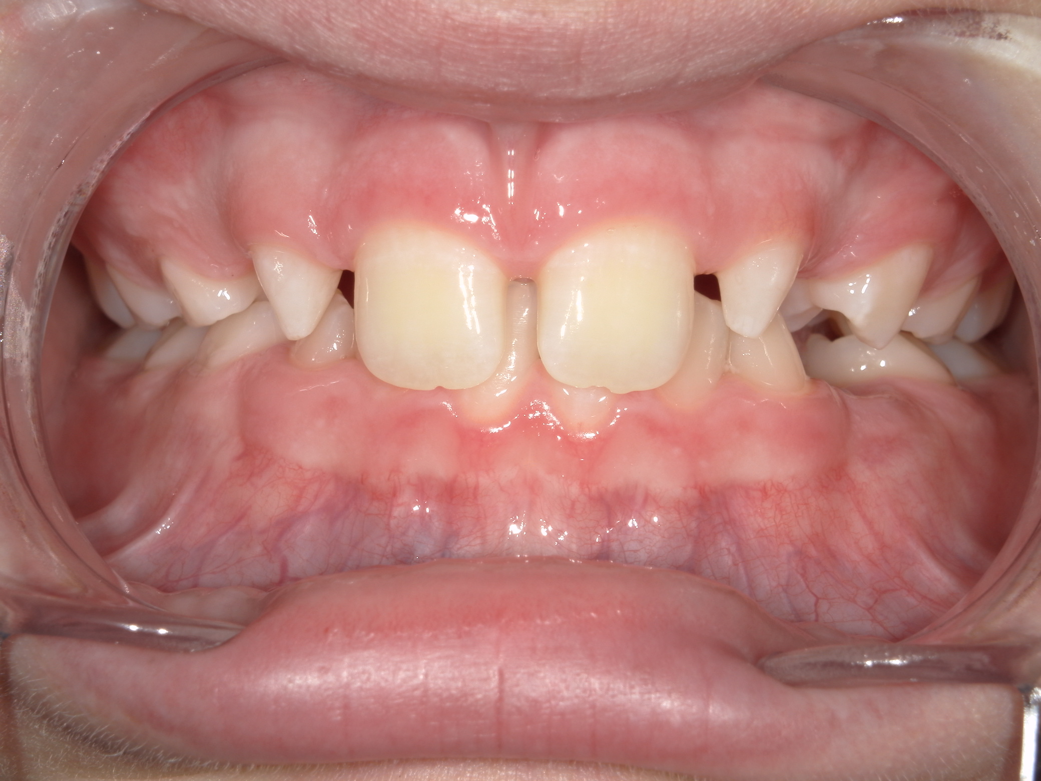 Smile Makeover