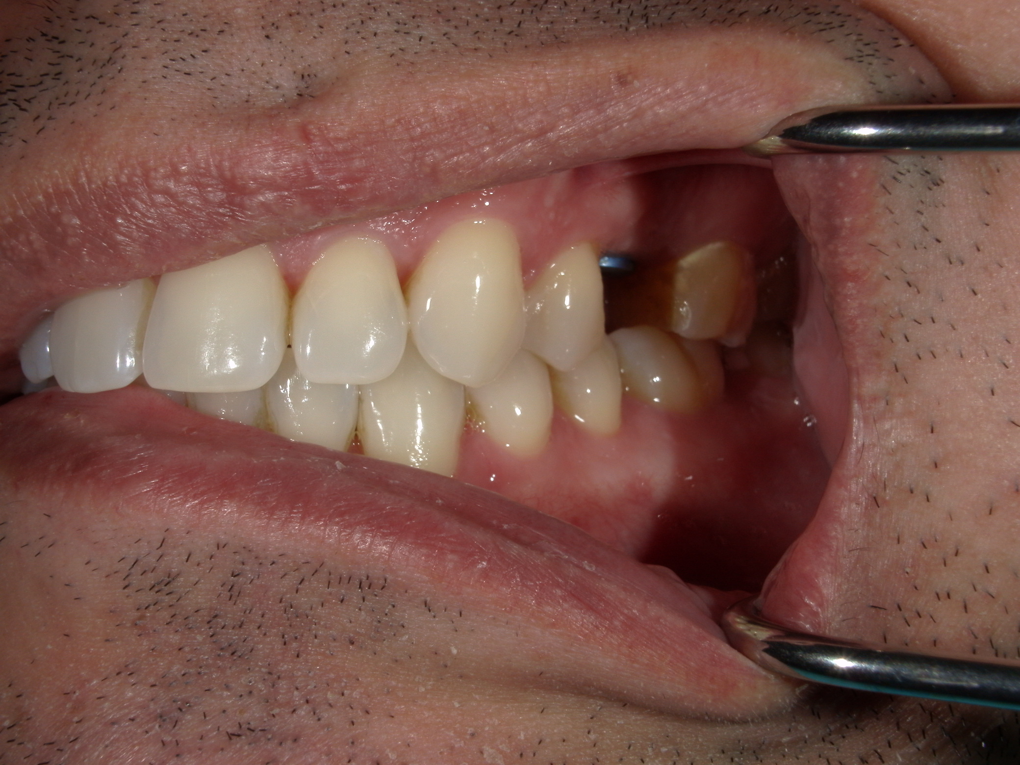 Smile Makeover