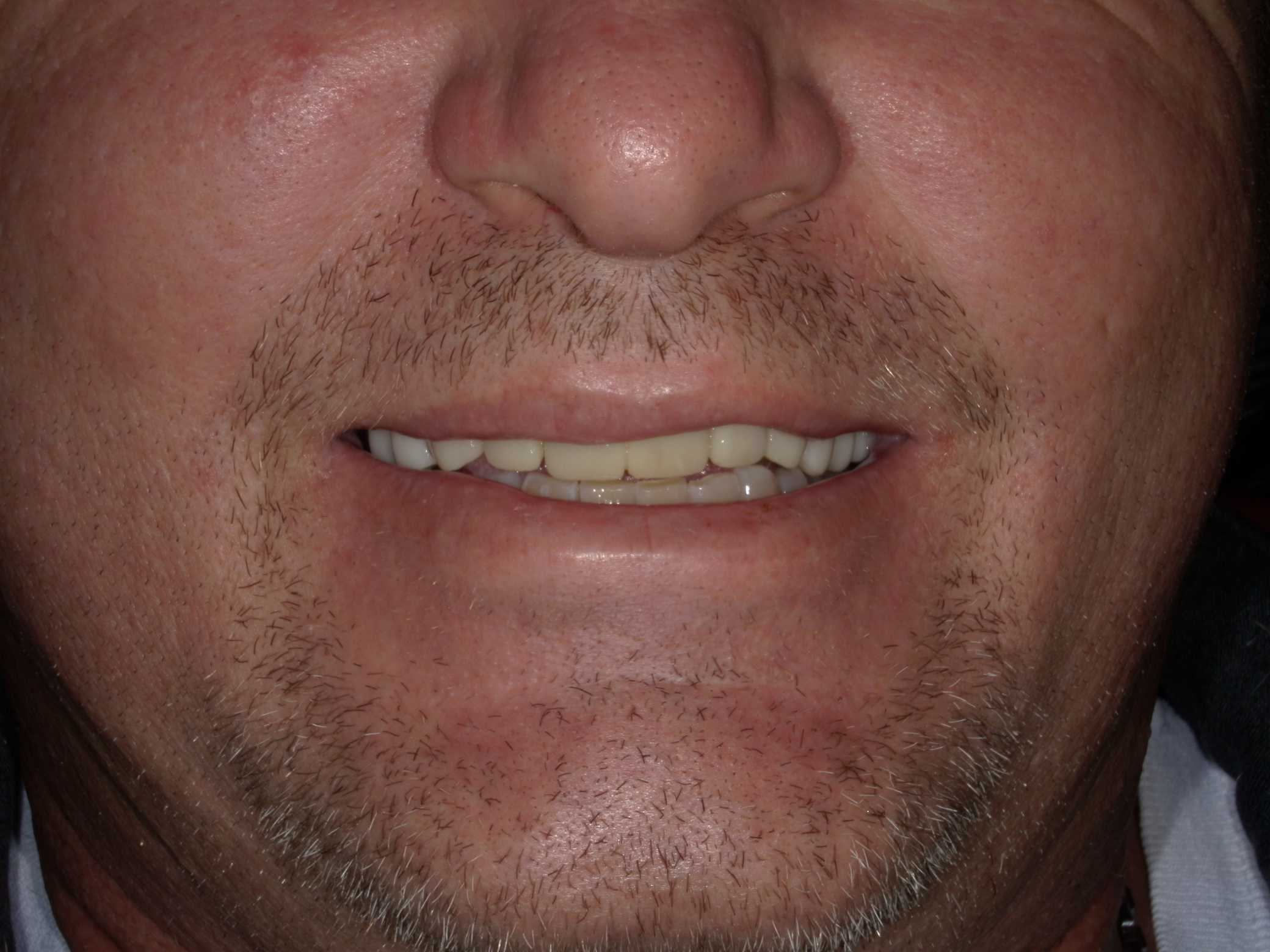 Smile Makeover
