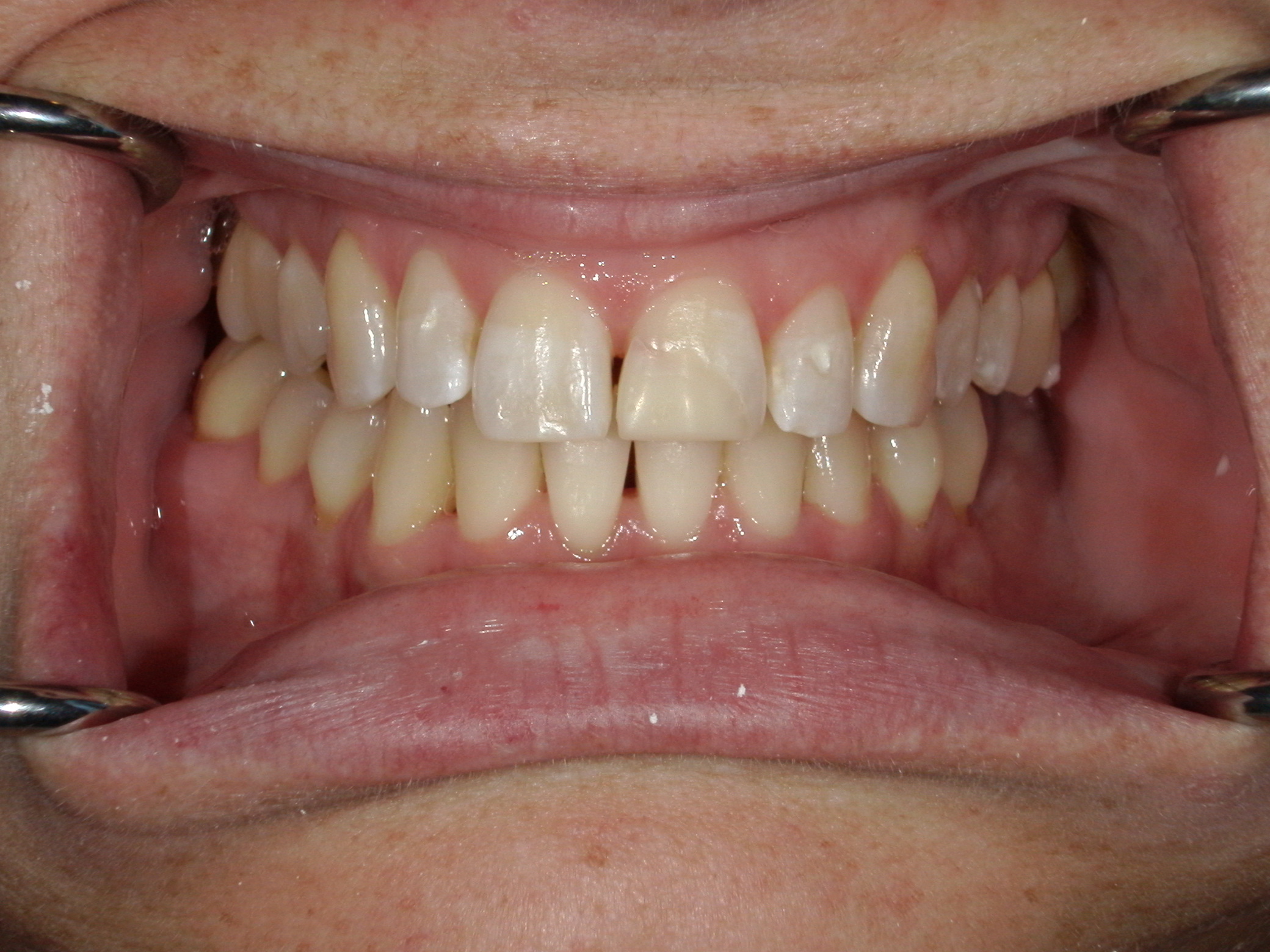 Smile Makeover