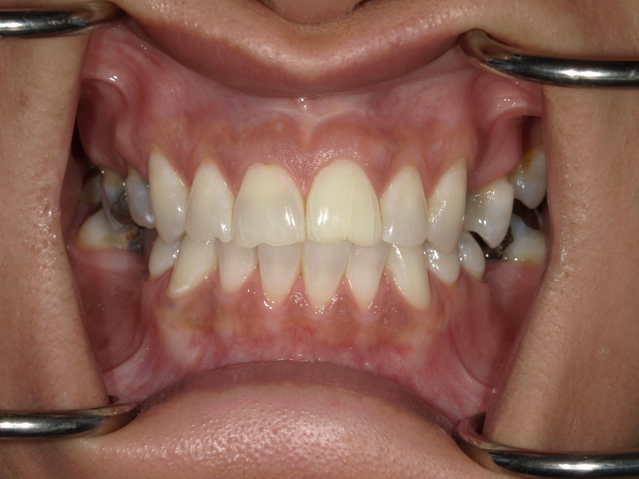 Smile Makeover