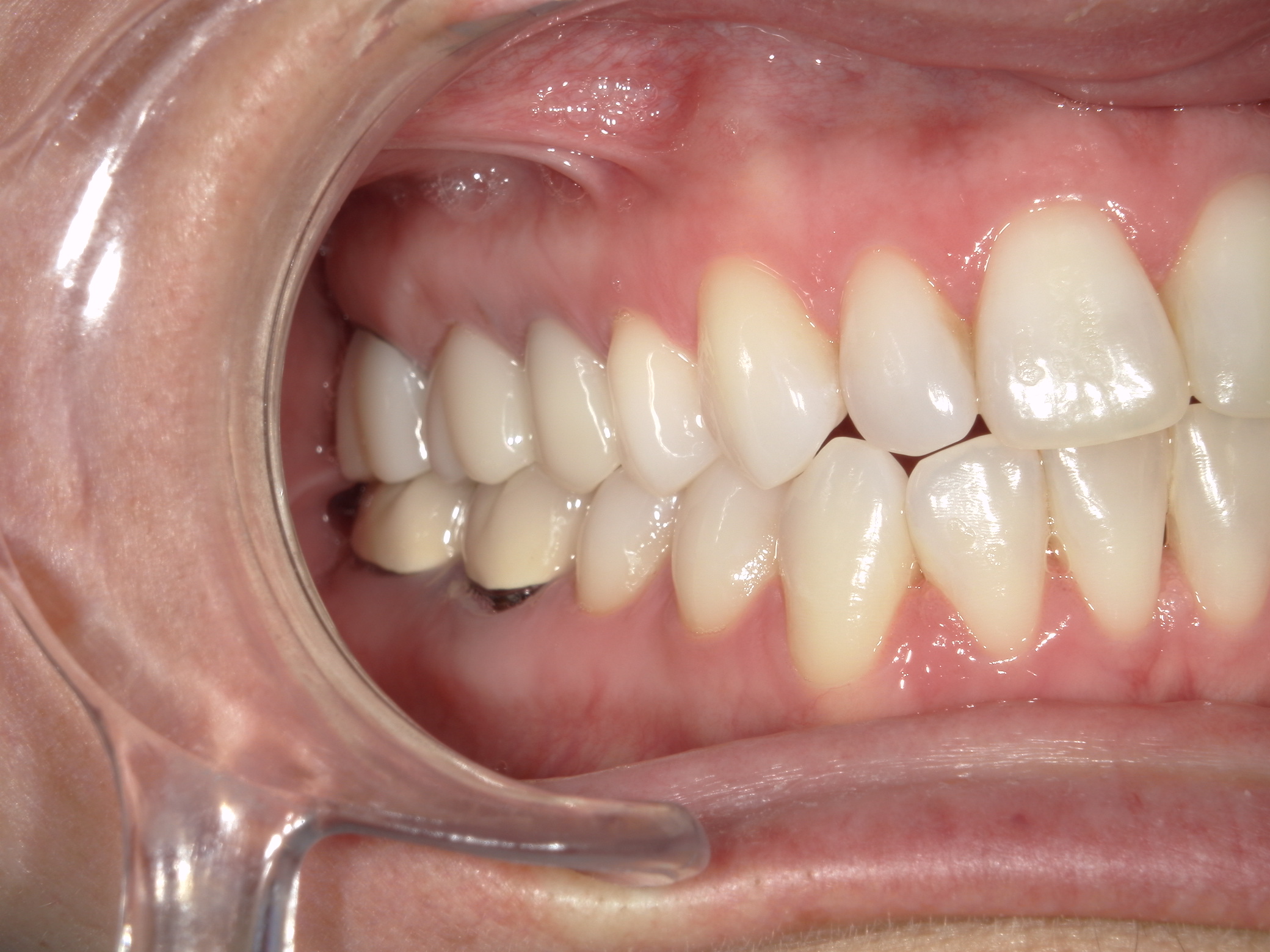 Smile Makeover