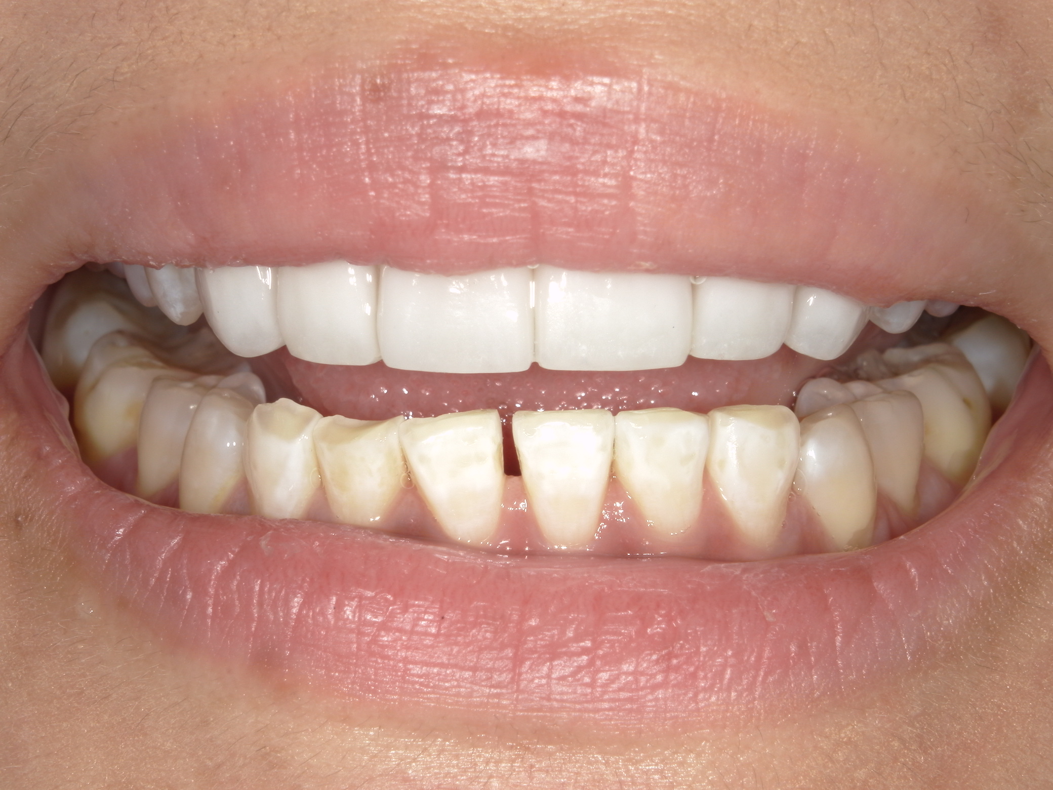 Smile Makeover
