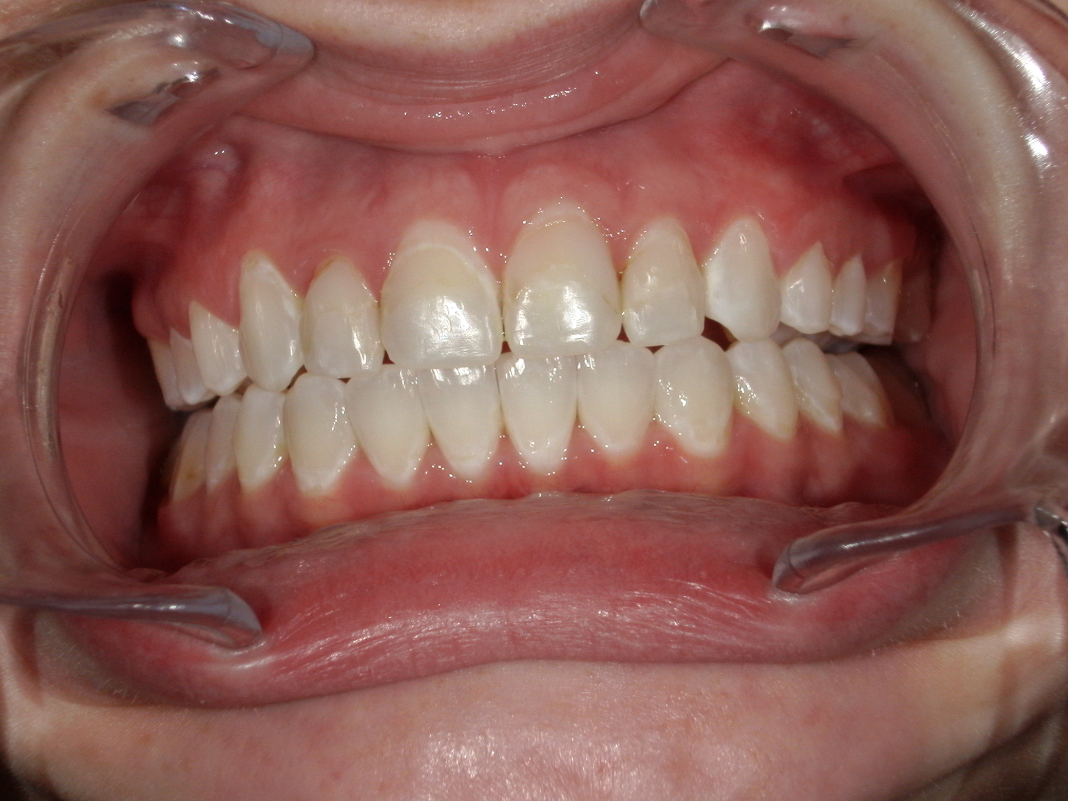 Smile Makeover