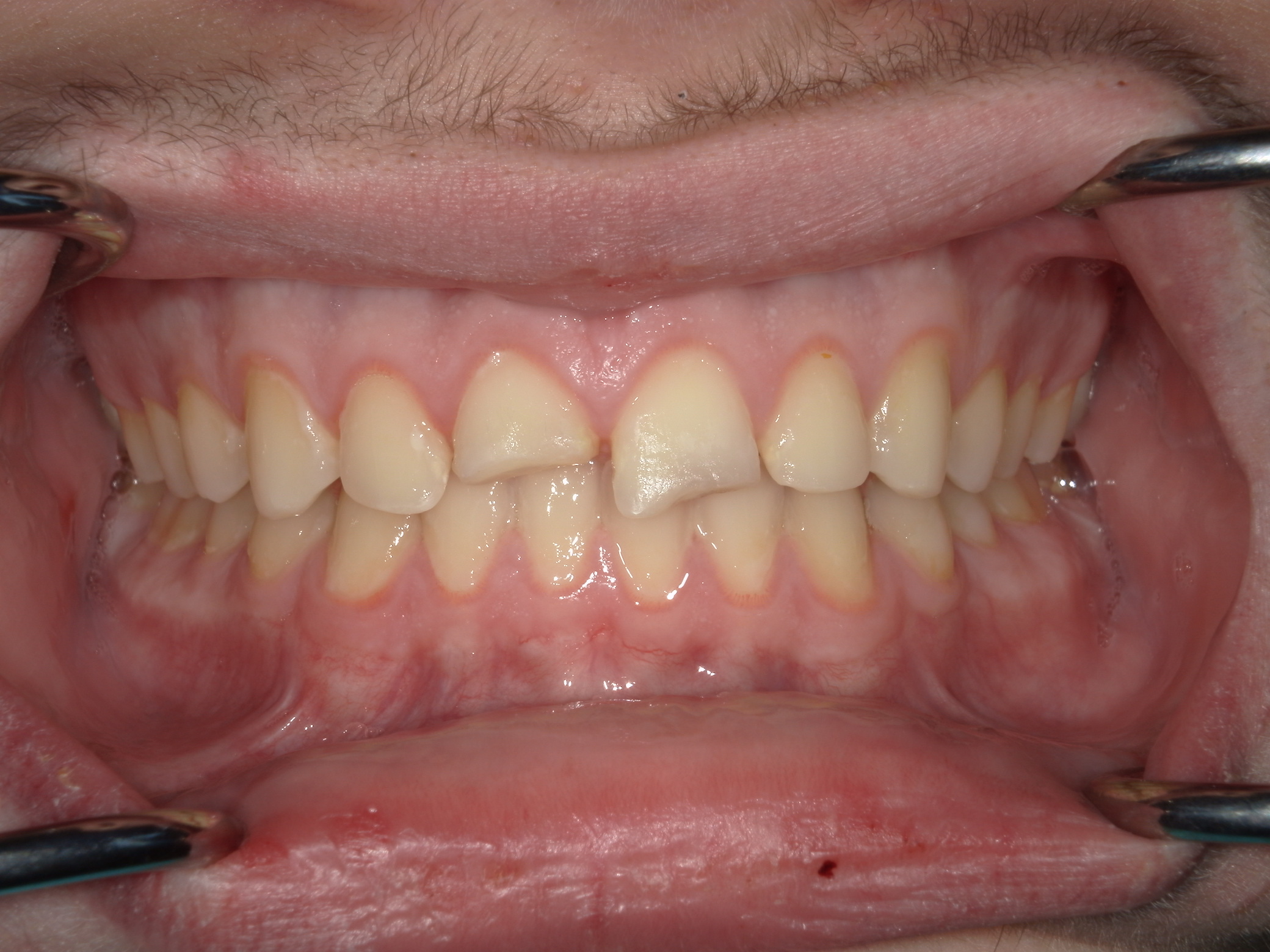 Smile Makeover