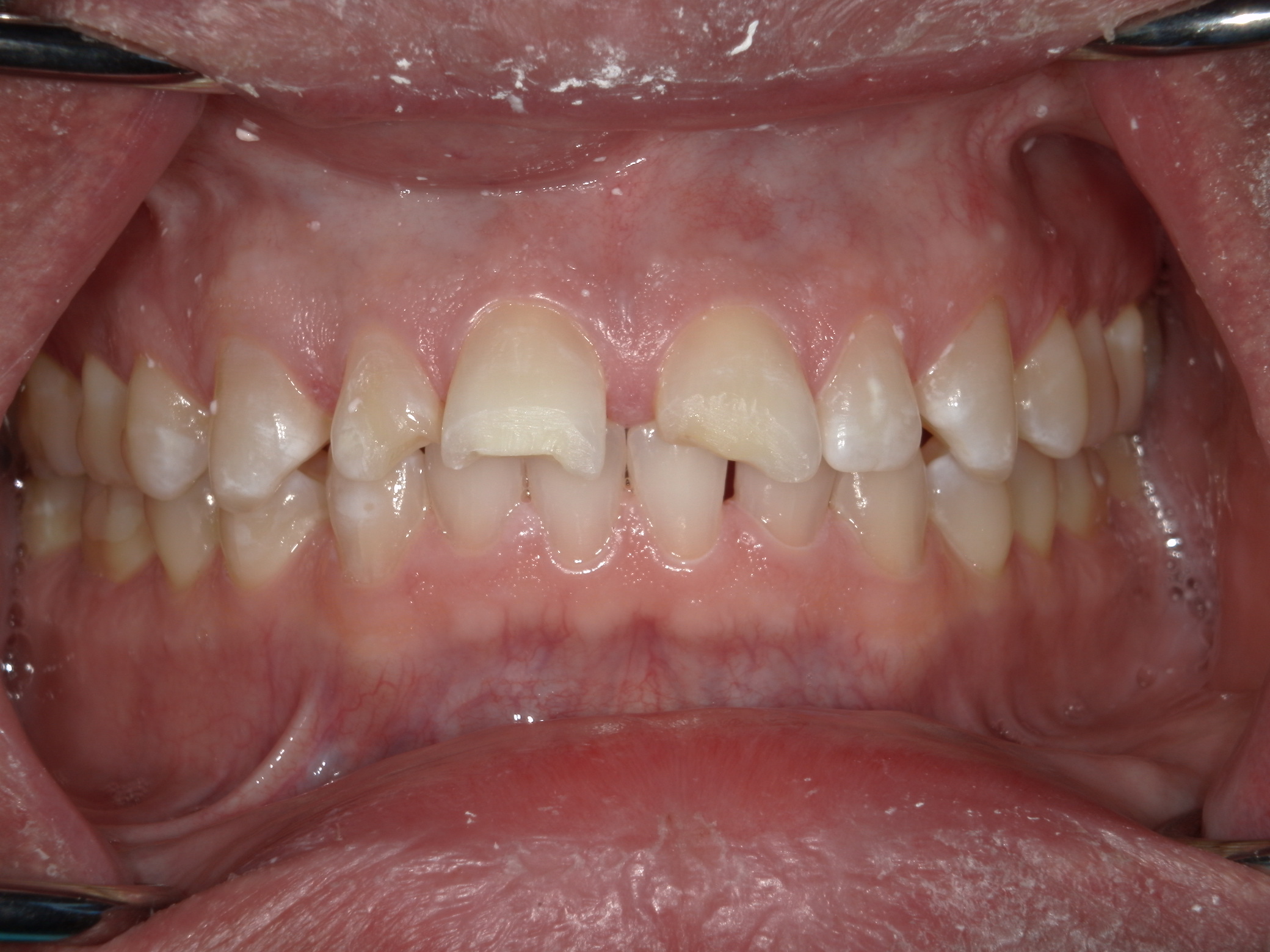 Smile Makeover