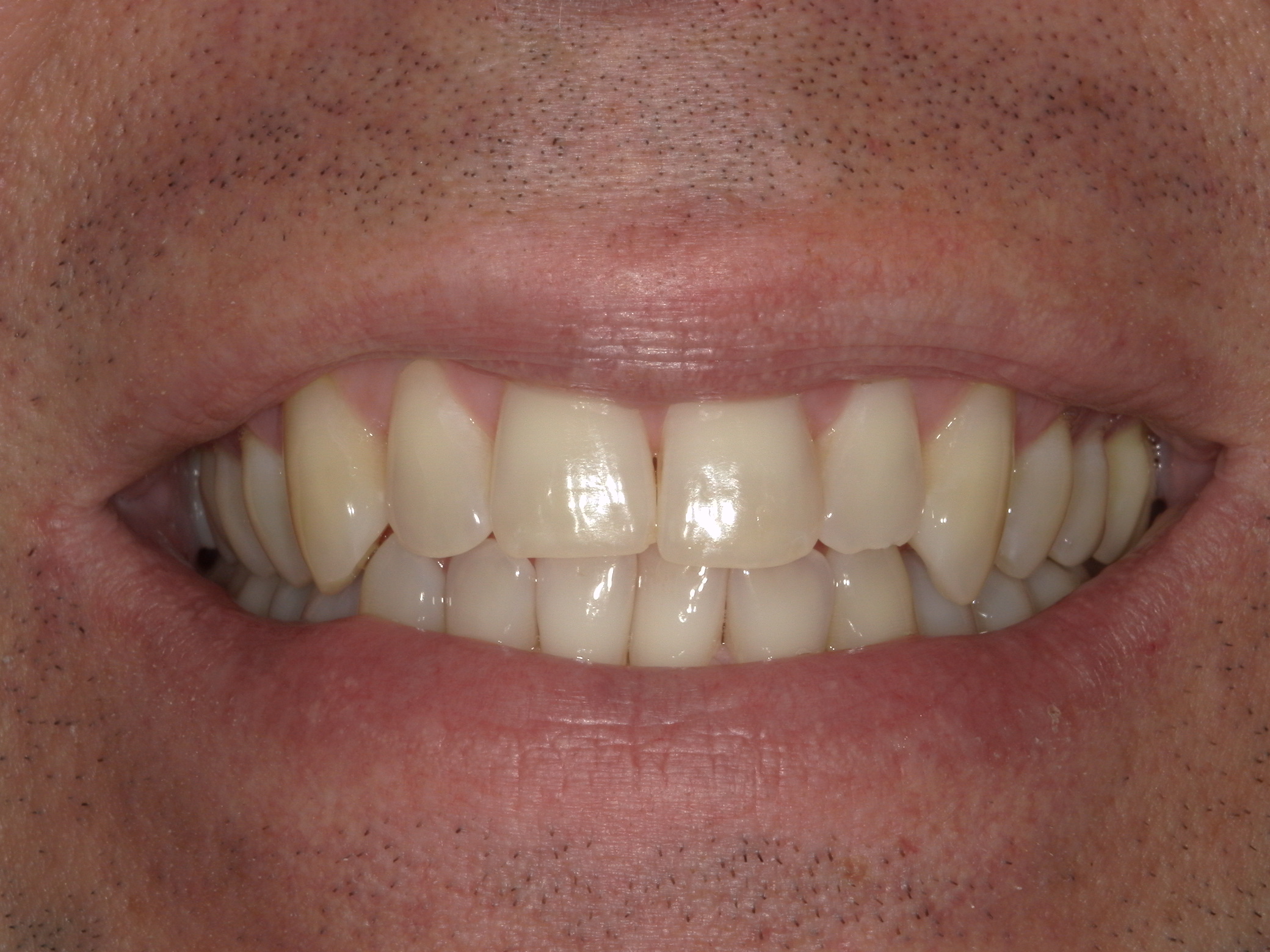 Smile Makeover