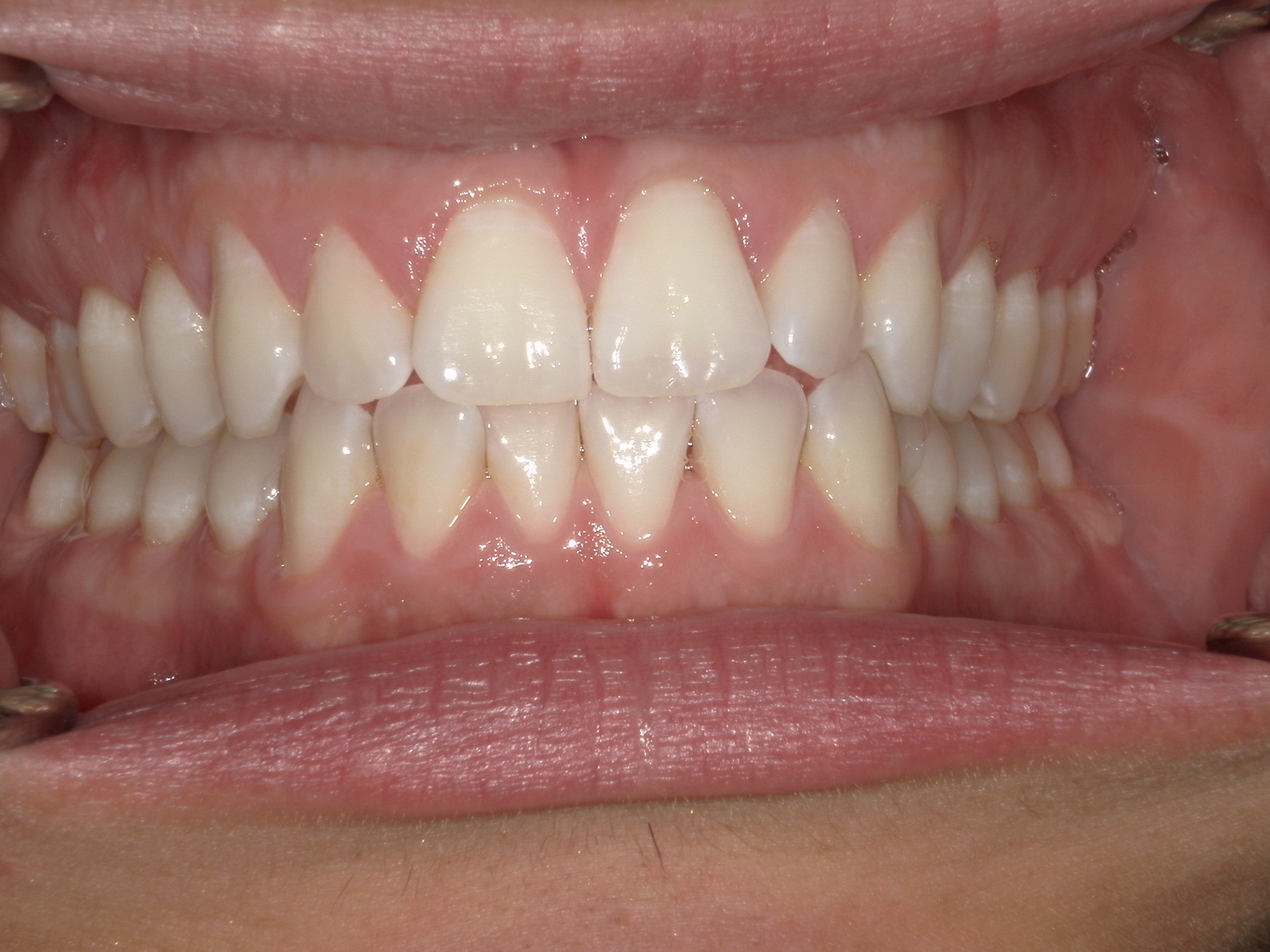 Smile Makeover