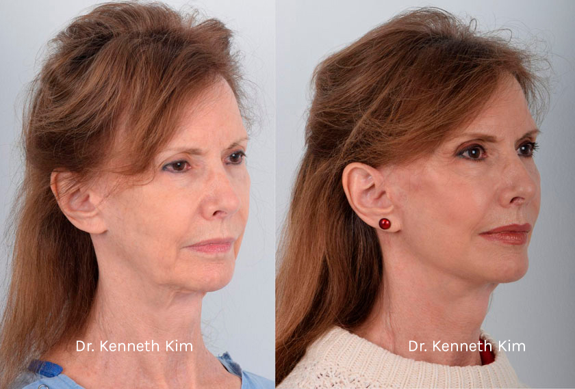 Facelift result at Dr. Kenneth Kim Plastic Surgery - Dream Medical Group