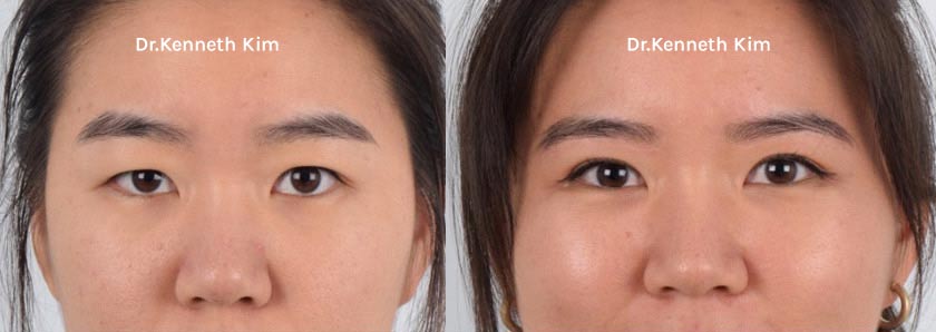 Blepharoplasty result at Dr. Kenneth Kim Plastic Surgery - Dream Medical Group