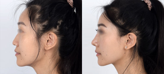 Rhinoplasty result at Dr. Kenneth Kim Plastic Surgery - Dream Medical Group