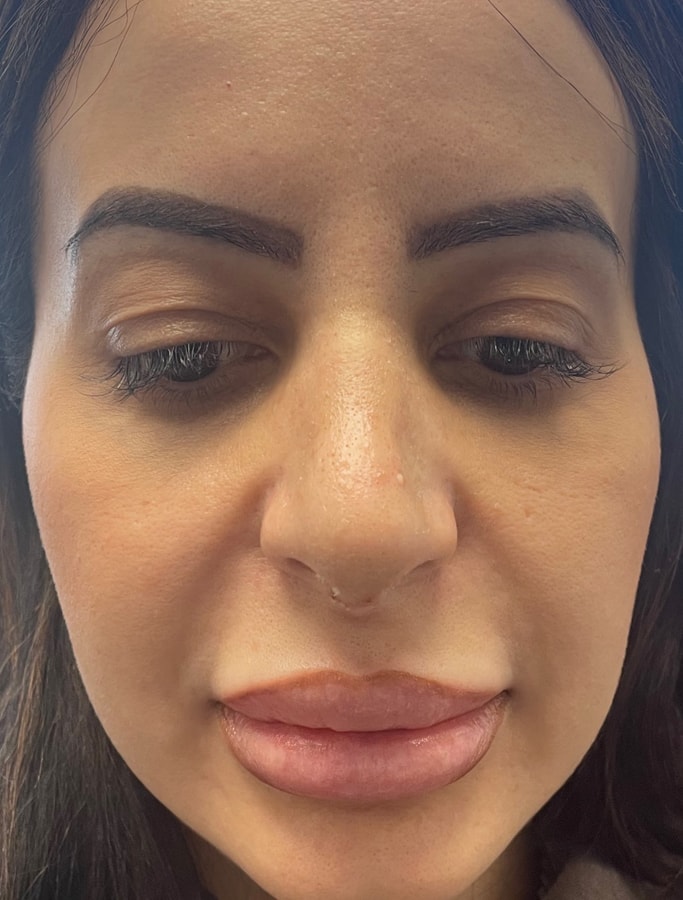 A result from Cohn Plastic Surgery