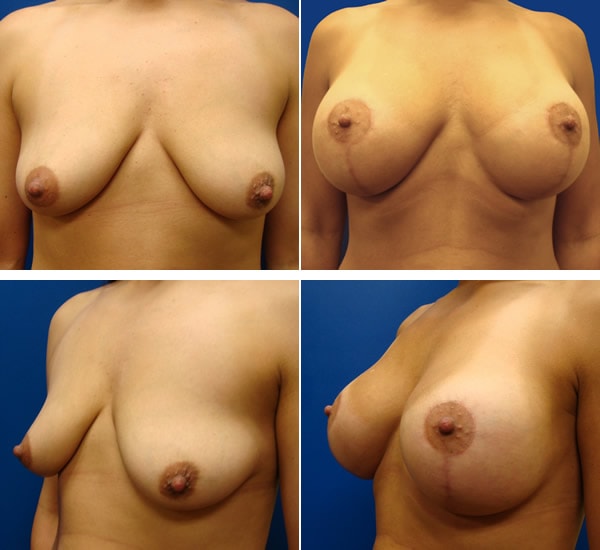 A result from Plastic Surgeon Richard Fryer
