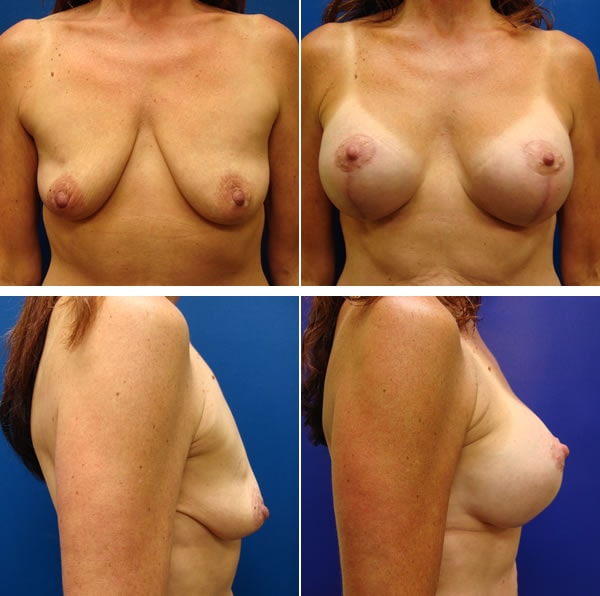 A result from Plastic Surgeon Richard Fryer