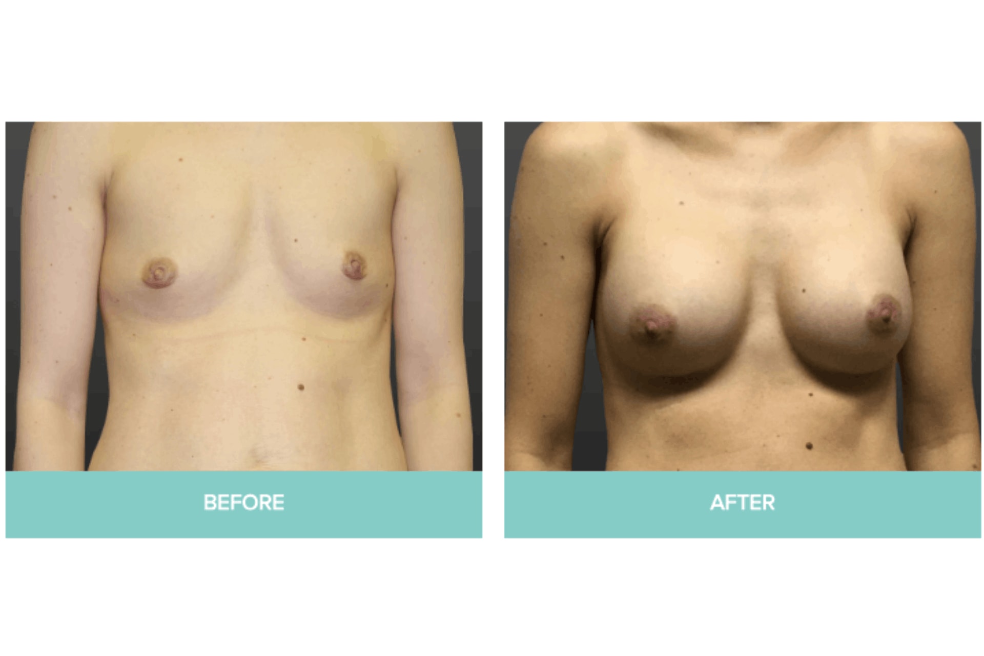 A result from Midwest Breast & Aesthetic Surgery