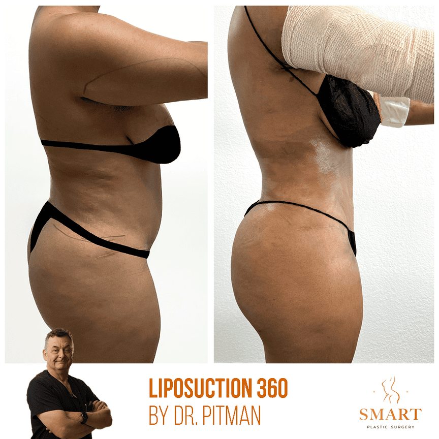 Liposuction result at Smart Plastic Surgery