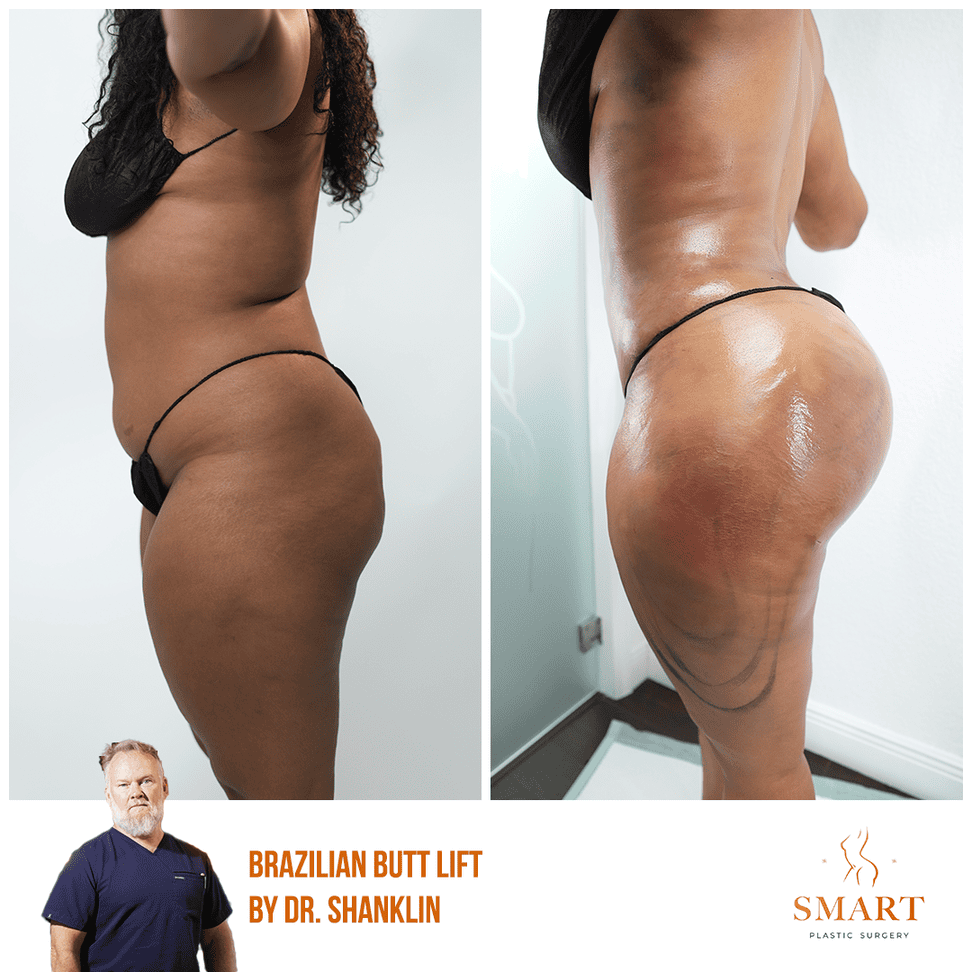Breast Augmentation result at Smart Plastic Surgery