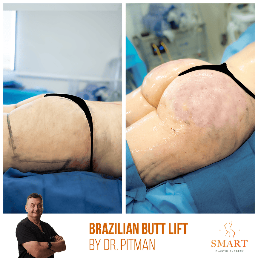 Bbl result at Smart Plastic Surgery