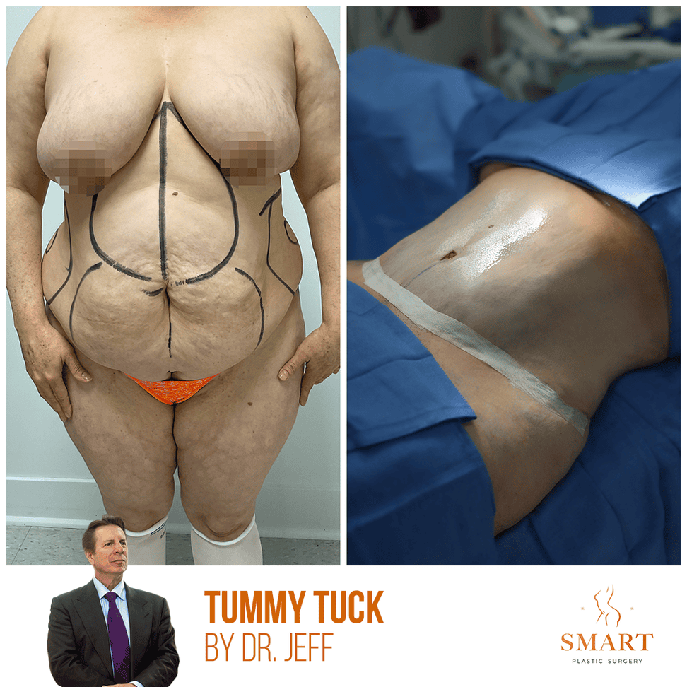 Breast Augmentation result at Smart Plastic Surgery