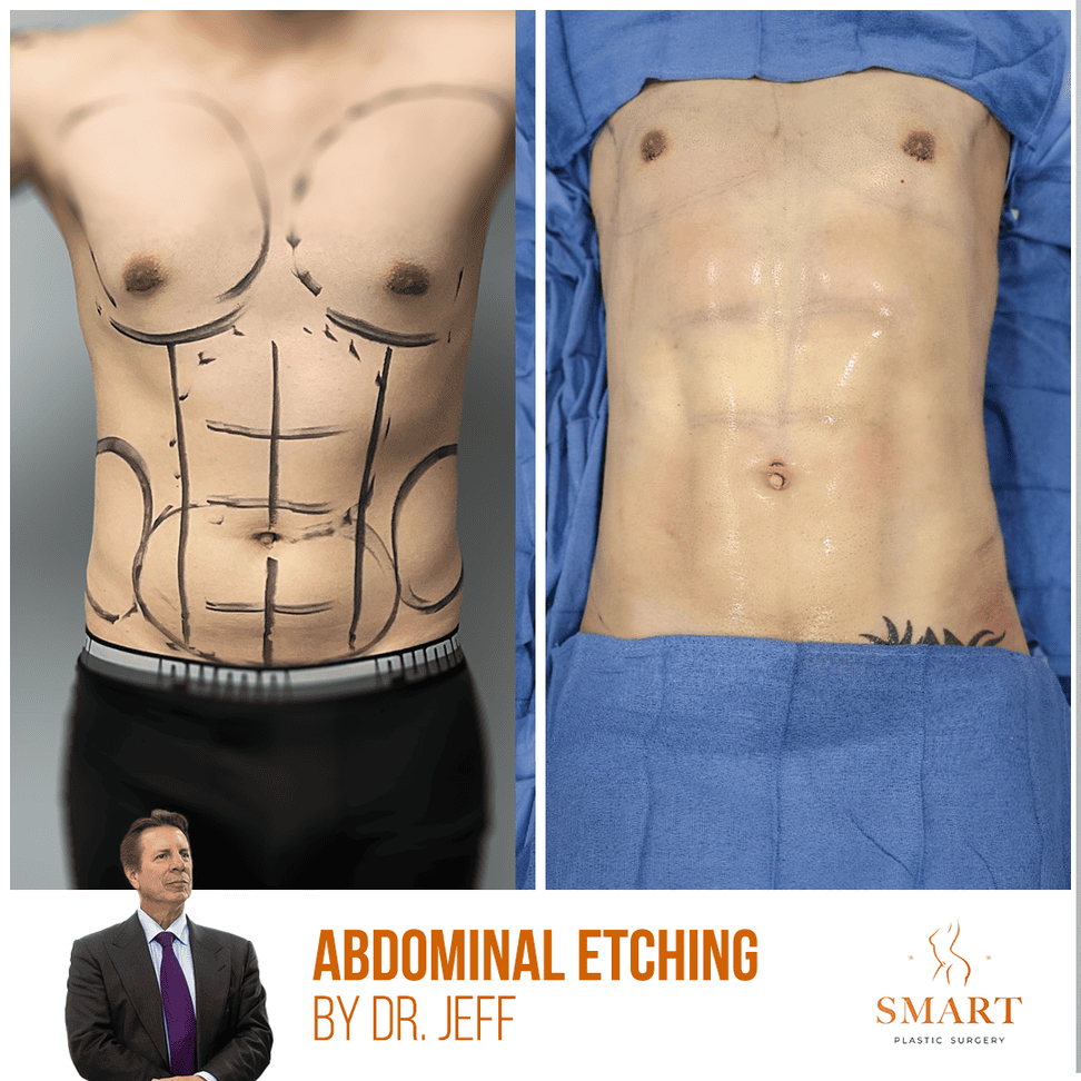 Liposuction result at Smart Plastic Surgery