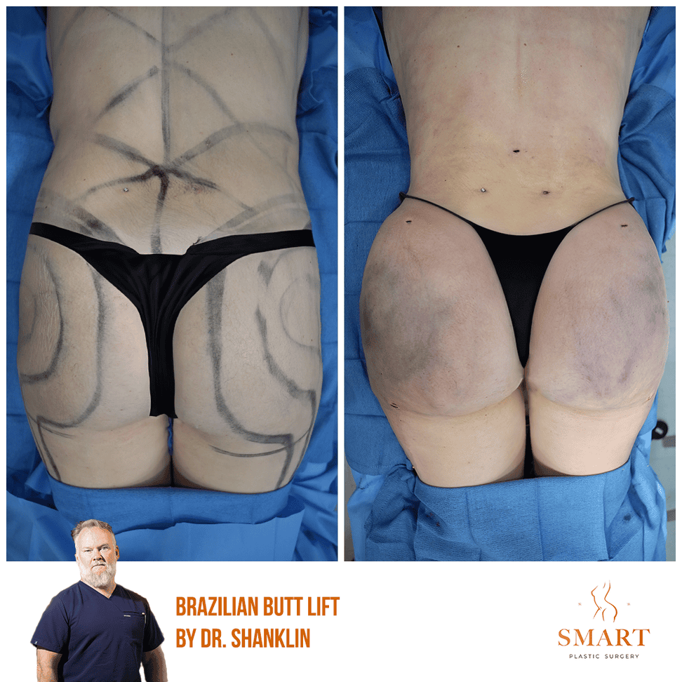 Breast Augmentation result at Smart Plastic Surgery