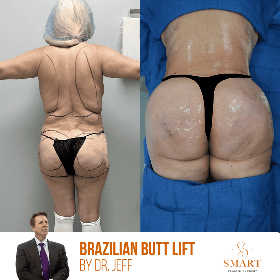 Liposuction result at Smart Plastic Surgery
