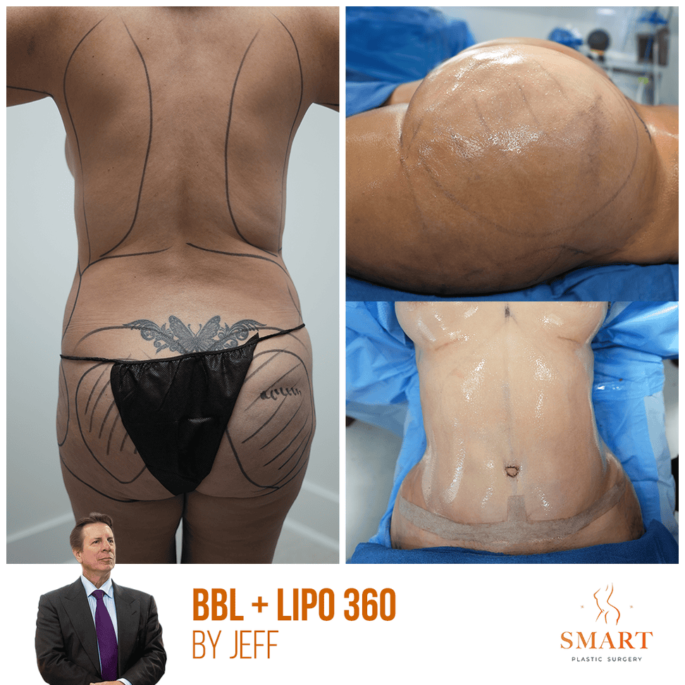 Breast Augmentation result at Smart Plastic Surgery