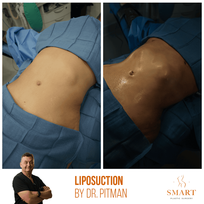 Liposuction result at Smart Plastic Surgery
