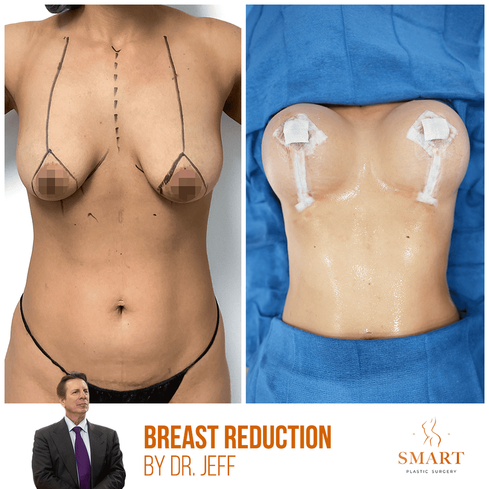 Breast Augmentation result at Smart Plastic Surgery