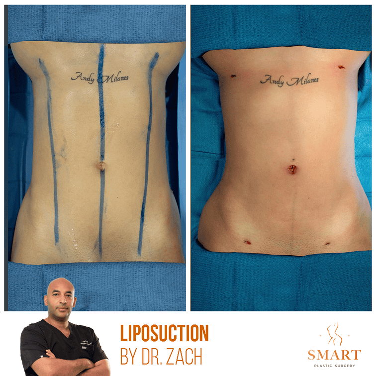 Liposuction result at Smart Plastic Surgery