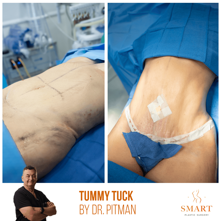 Liposuction result at Smart Plastic Surgery