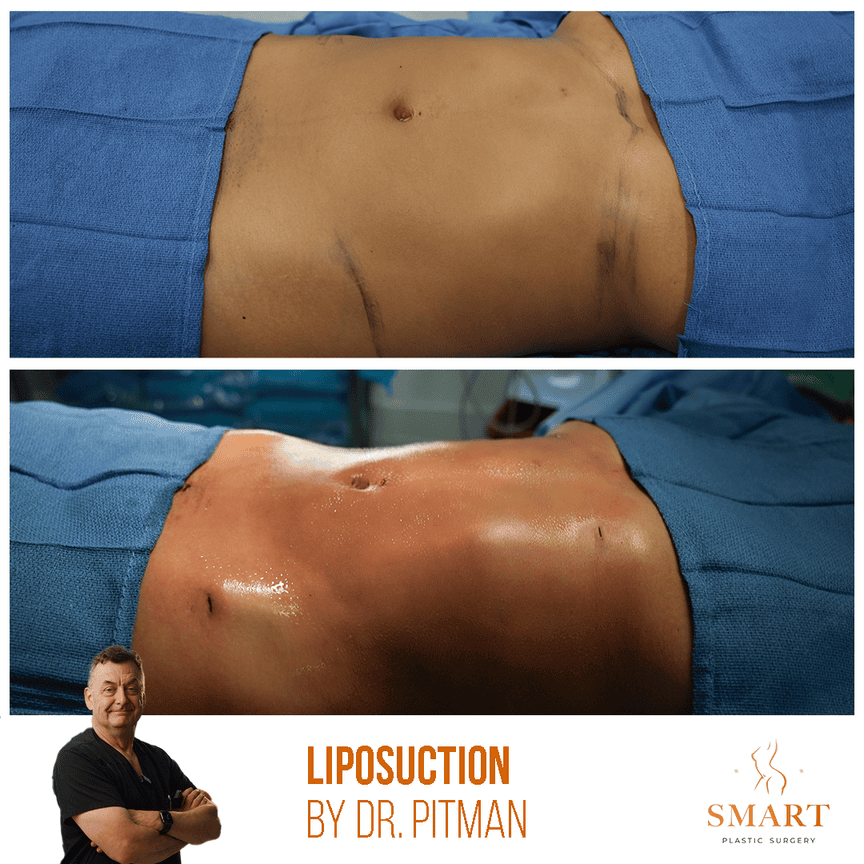 Liposuction result at Smart Plastic Surgery