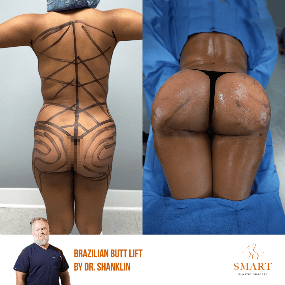 Breast Lift result at Smart Plastic Surgery