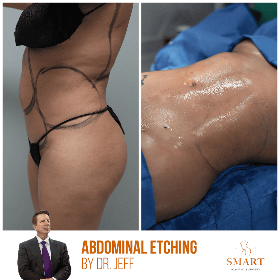 Bbl result at Smart Plastic Surgery