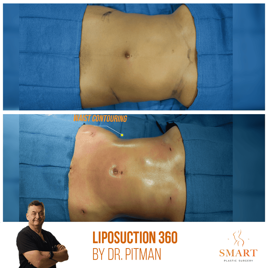 Liposuction result at Smart Plastic Surgery